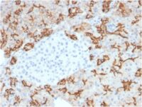 Formalin-fixed, paraffin embedded human pancreaticcarcinoma sections stained with 100 ul anti-TROP2 (clone TACSTD2/2153) at 1:200. HIER epitope retrieval prior to staining was performed in 10mM Citrate, pH 6.0.